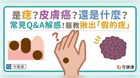 手臂痣長毛代表什麼|是痣？皮膚癌？還是什麼？常見Q&A解惑！醫教揪出「。